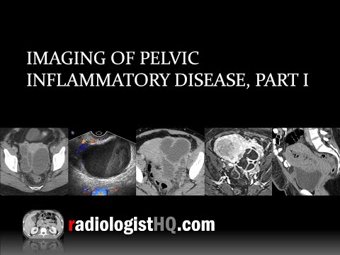 Imaging of Pelvic Inflammatory Disease, Part I