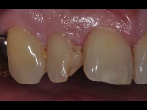 TEMPSMART: Technique Video with Dr Mark Kleive