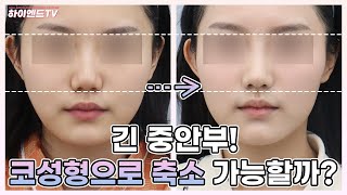[케이스 리뷰] 긴 중안부로 스트레스 받는 사람? 성형전후비교 l 성형리뷰
