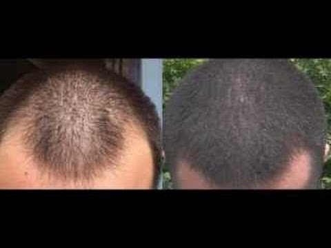 Minoxidil ( Arganrain ) - A Quick How to Guide with Before & After results
