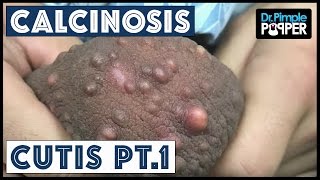 Removing Calcinosis Cutis: Pt.1