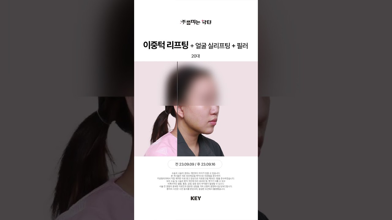 20대 이중턱리프팅 실리프팅 대구키성형외과