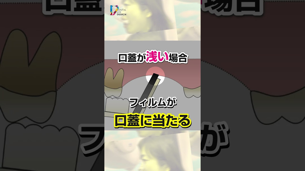 【口蓋が浅い患者さんの臼歯のデンタルの撮影ポイントについて教えてください(図で解説)】教えて相宮先生【歯科衛生士が知っておきたいデンタル撮影のポイント】#shorts