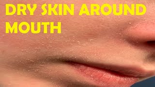 how to get rid of dry skin around mouth overnight