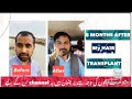 Hair Transplant 8 Months Result 2020 Hair Transplant Personal Experience Hair Care Pakistan