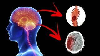 5 Warning Signs of a Stroke you should Never Ignore