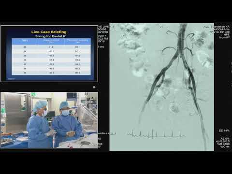 [TCTAP 2017] Valve Symposium - Live Case & Lecture Session I