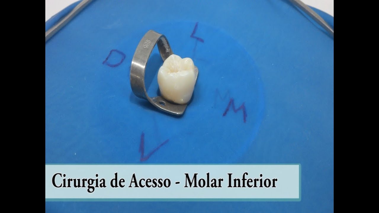 Molar Inferior - Cirurgia de Acesso