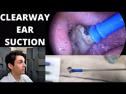 Soft Tip Suction Probe Used to Extract Dead Skin From Ears (Clearway Suction Tool)