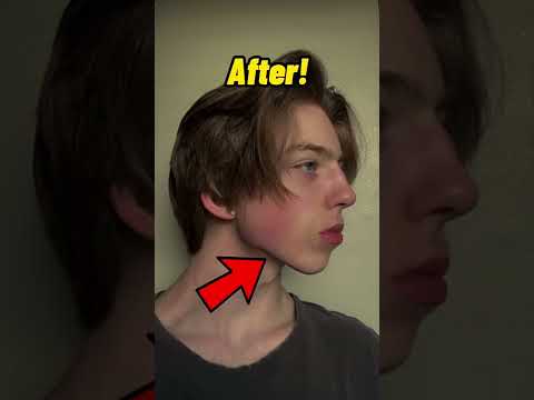 How to get a jawline