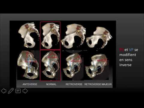 MPR R2 COURS 27 Equilibre sagittal du rachis  du normal au pathologique Caroline Parlier MD