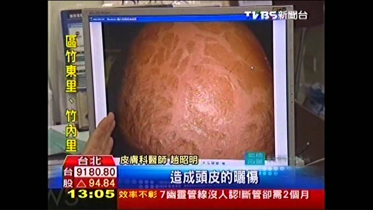禿髮忘「防曬」 炎夏頭皮曬傷增1成