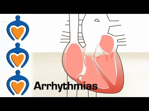 Arrhythmias - What is an arrhythmia and how is it treated?