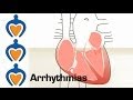 Arrhythmias What Is An Arrhythmia And How Is It Treated