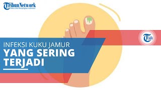 Onychomicosis, Infeksi Kuku Jamur yang Memang Sering Terjadi