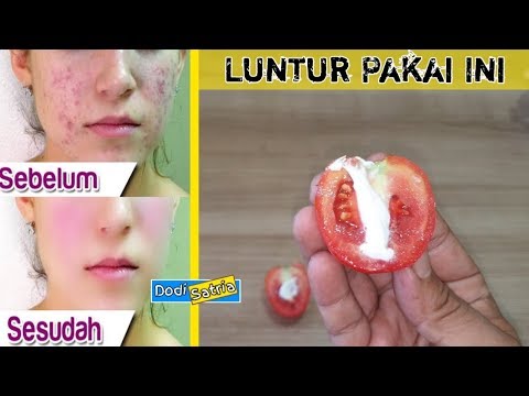 Cara Menghilangkan Jerawat Untuk Selamanya, artikel Cara Menghilangkan Jerawat Untuk Selamanya gratis, video trending Cara Menghilangkan Jerawat Untuk Selamanya
