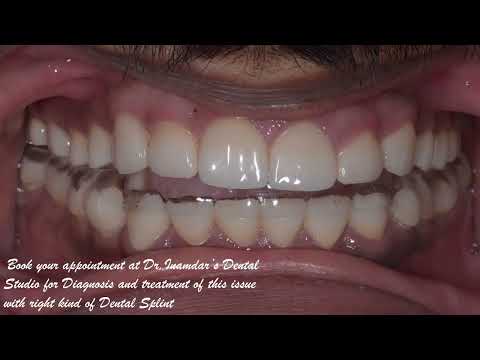 Dental Splint