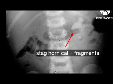 RIRS for complete clearance of fragments post mini PCNL @Pediatric-Urologist