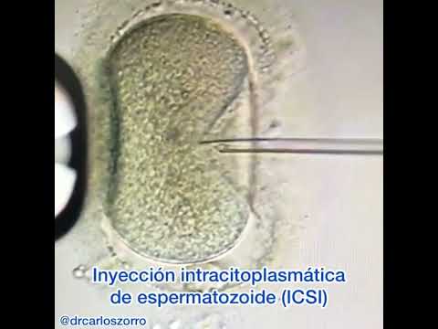 Como se realiza la fertilización in vitro por el Dr. Carlos Zorro en Bogotá