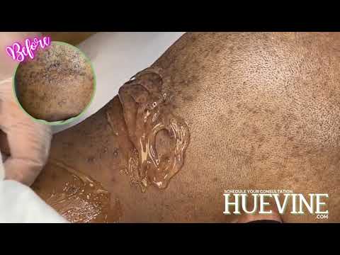 Laser Hair Removal (On Back Of Head) | HueVine