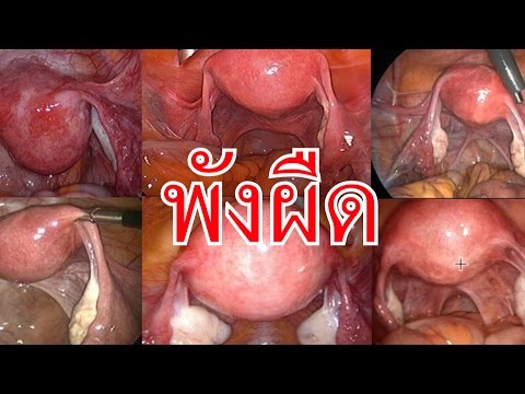 การทำงานและต่อมลูกหมากแรง ประโยชน์ยี่หร่าดำแรง