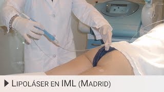 Laserlipólisis (Lipoláser® o liposucción por láser) - Instituto Médico Láser - IML - Instituto Médico Láser