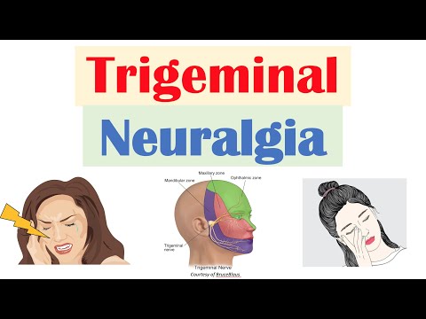 Trigeminal Neuralgia (“Severe Facial Pain”): Causes, Pathophysiology, Symptoms, Diagnosis, Treatment