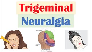 Trigeminal Neuralgia (“Severe Facial Pain”): Causes, Pathophysiology, Symptoms, Diagnosis, Treatment