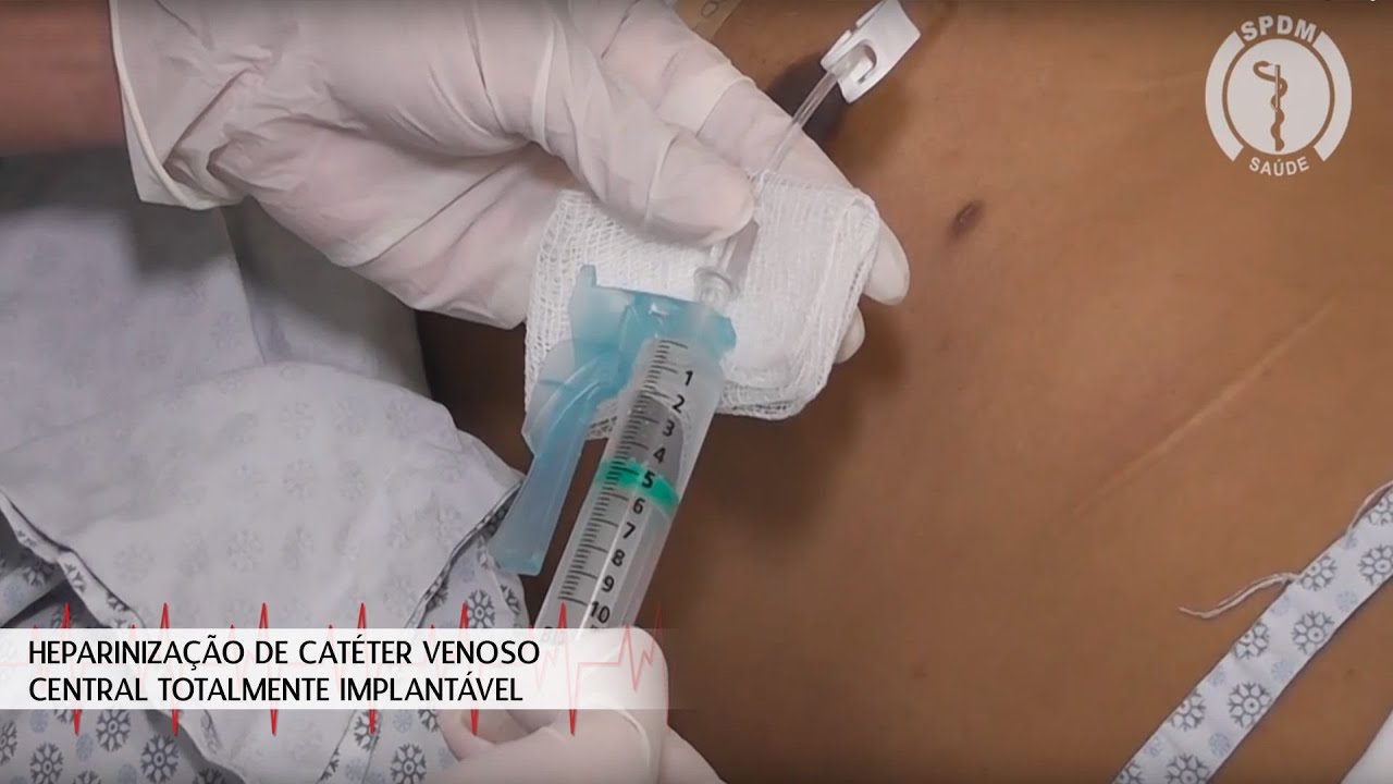 Heparinização Cateter Venoso Central Totalmente Implantavel