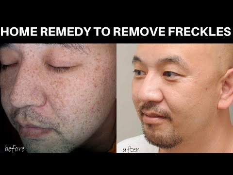 REMOVE FRECKLES & DARK SPOTS NATURALLY