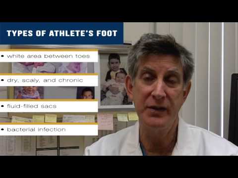 How can I tell if I have Athlete's Foot? What Causes Athlete's Foot?