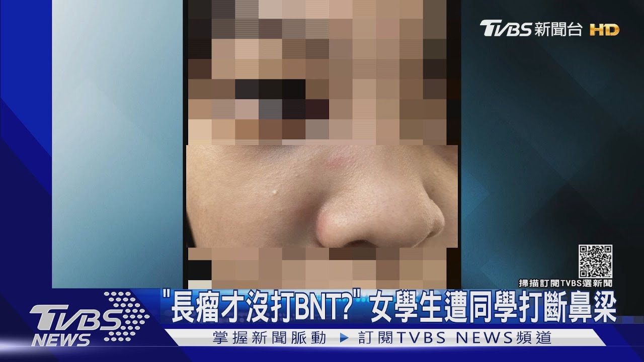 「長瘤才沒打BNT?」 女學生遭同學打斷鼻樑