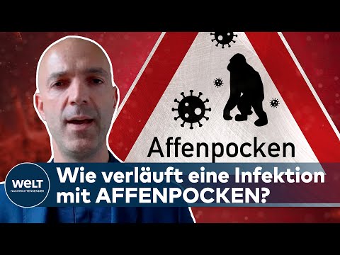 „Sollten Affenpocken nicht mit der Coronavirus-Pandemie vergleichen“ - VIROLOGE SCHMIDT-CHANASIT