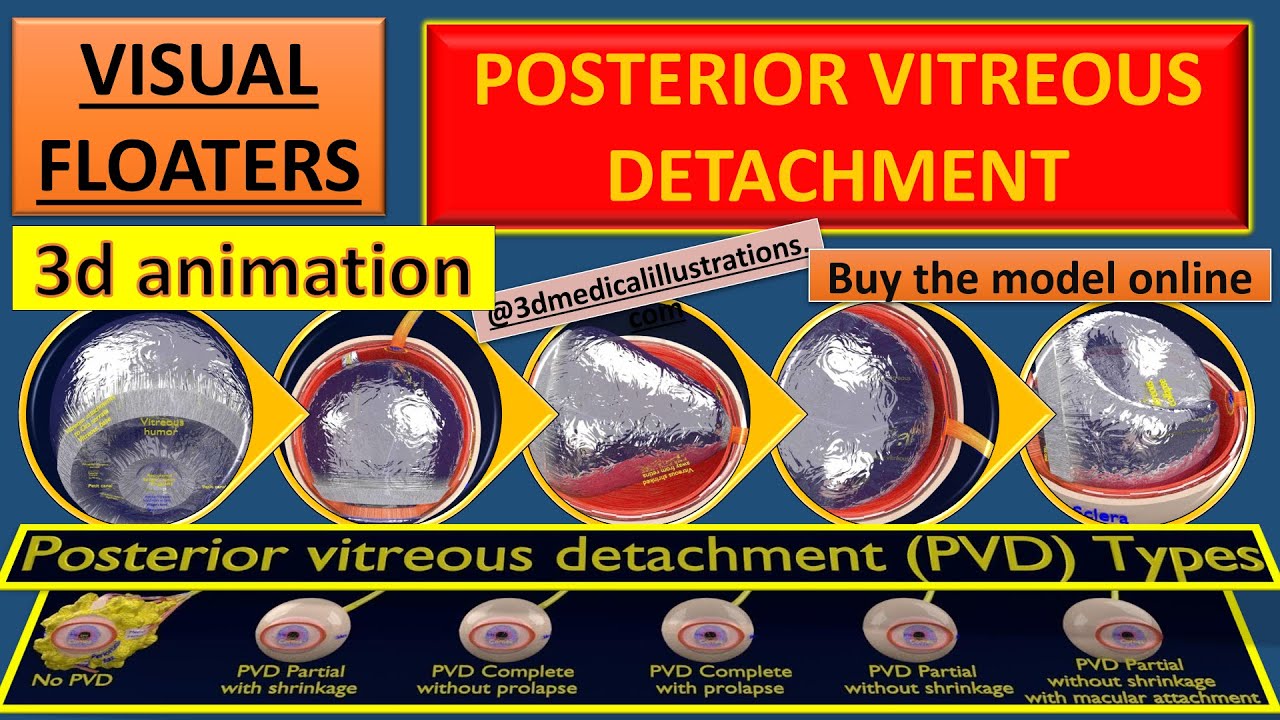 Posterior vitreous detachment types eye 3D Model