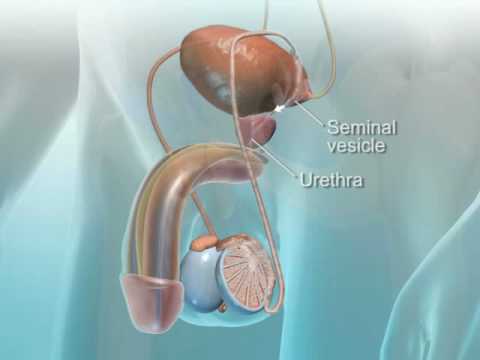 Adenocarcinoma de prostata gleason 7 34