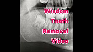Step by Step Wisdom Tooth Extraction with Tips
