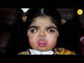 She S Nonverbal But Loves Making Friends Pfeiffer Syndrome