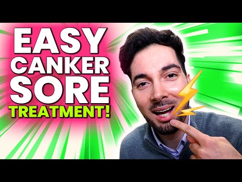 How To Get Rid Of Canker Sores Treatment