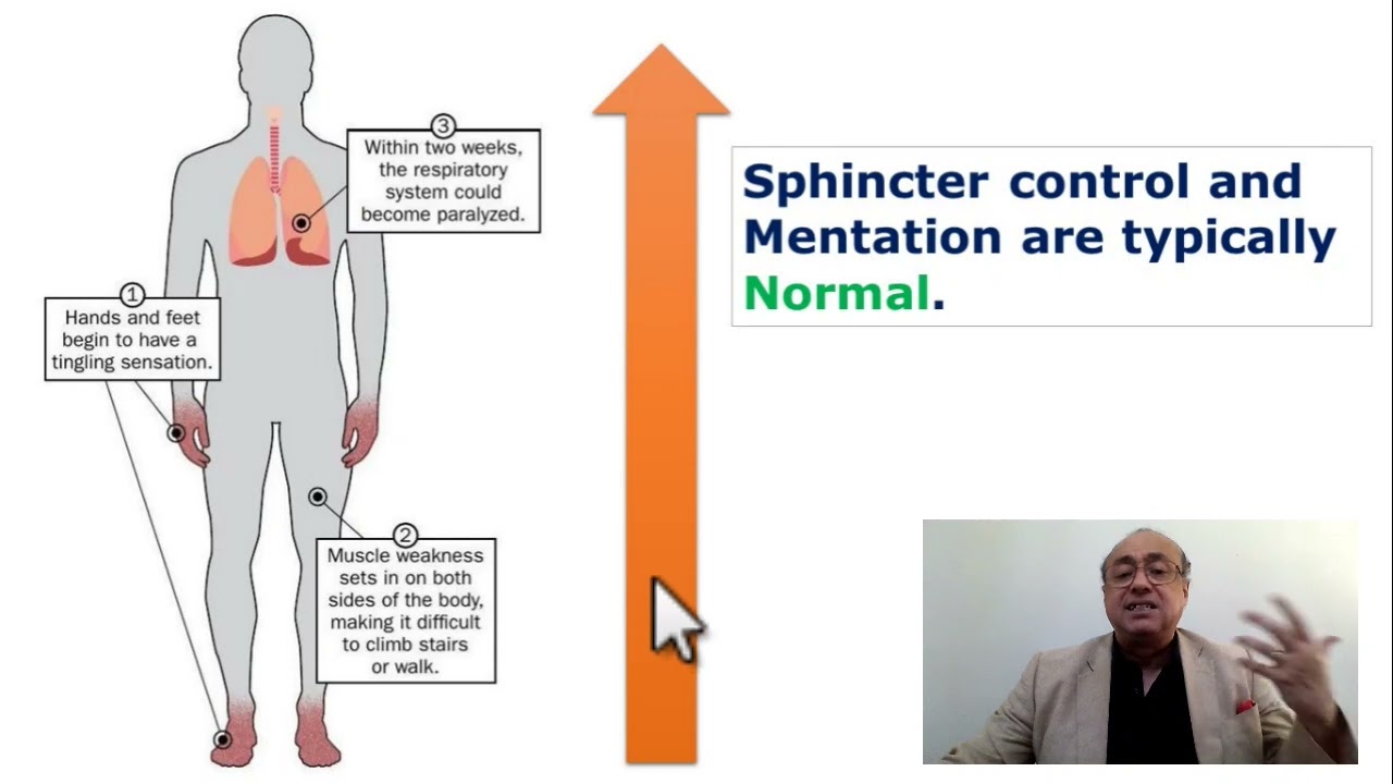 Guillain-Barre Syndrome (Acute ascending polyneuropathy)
