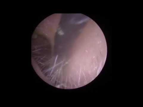 SImple wax removal with jobson horne.