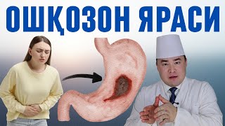 ОШҚОЗОН ЯРАСИ ВА ДАВО ЧОРАЛАРИ, САБАБЛАРИ, БЕЛГИЛАРИ ВА БАФУРЖА МАЪЛУМОТ, ЯЗ?