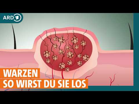 Warzen: So werden sie behandelt I ARD Gesund