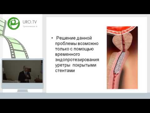 Курбатов Д Г - Применение временных покрытых нитиноловых стентов в лечении стриктур уретры