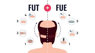 FUSS+FUE Combined Hair Transplant Procedure