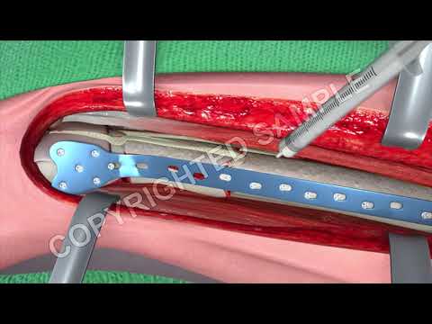 Broken Leg Surgery Femur Fracture Animation