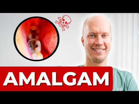 Sollte man Amalgam entfernen? 4 wichtige Gründe