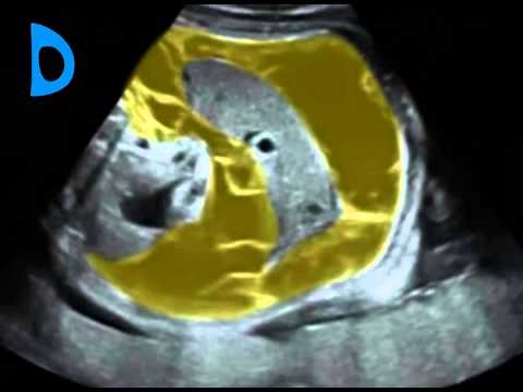 Fetal Medicine Foundation - Meconium peritonitis, 30 weeks