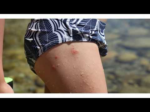 Kaysa sa paggamot sa halamang-singaw sa feces sa isang bata Halaman ng selandine super sa paggamot ng kuko halamang-singaw