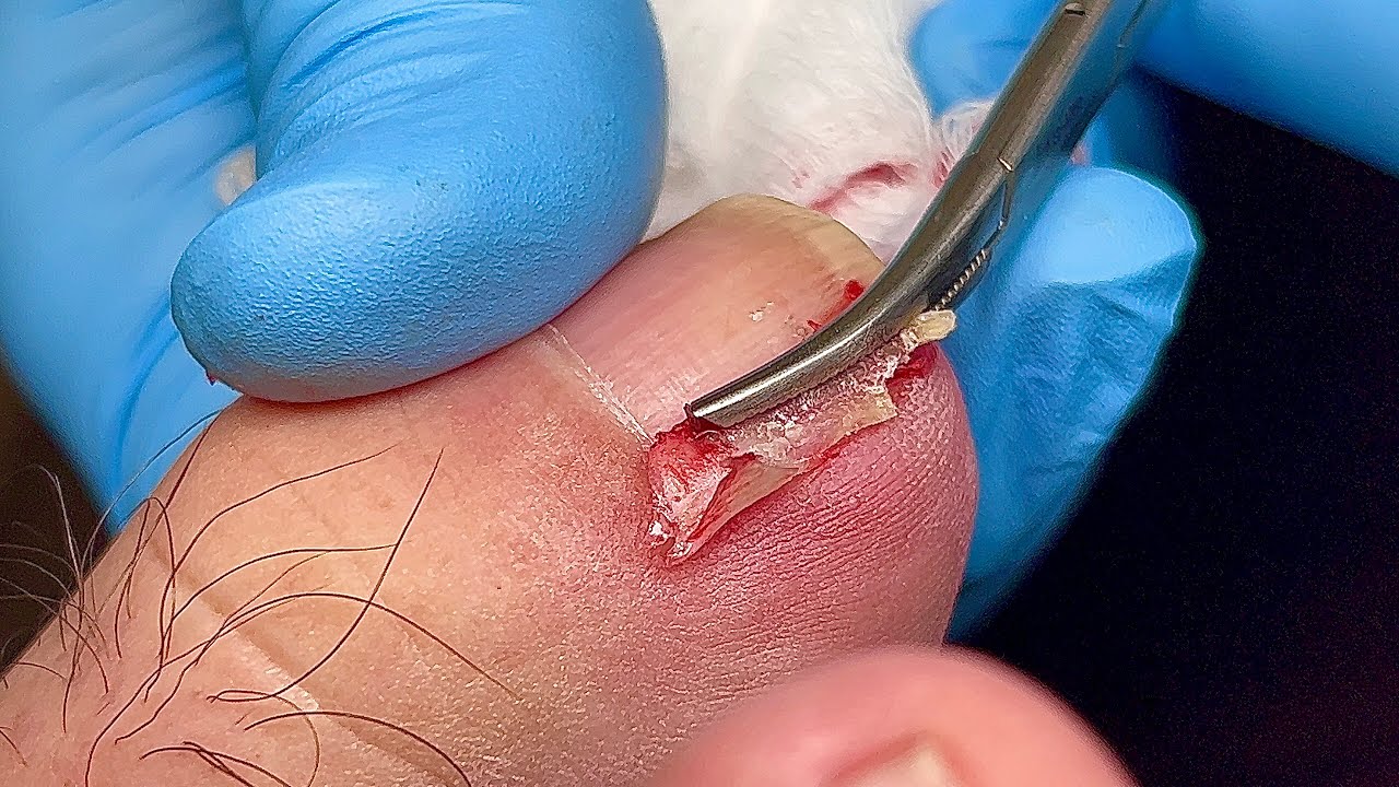 SATISYING INGROWN TOENAIL REMOVAL 😎