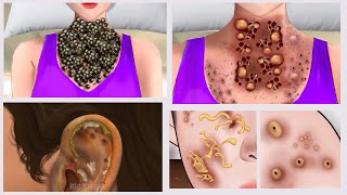 ASMR Blackhead & Whitehead Removal | Animated Acne Treatment